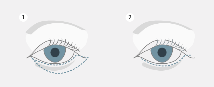 Unterlidstraffung, allaboutyoureyes