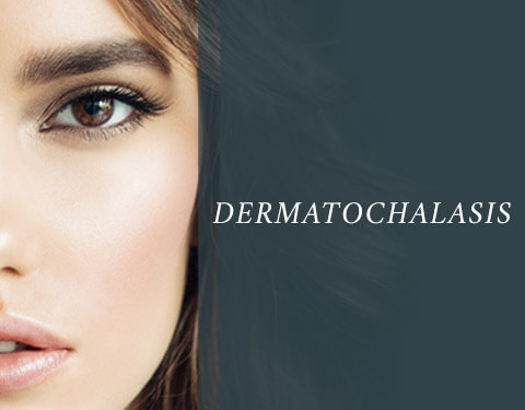 Dermatochalasis, allaboutyoureyes 